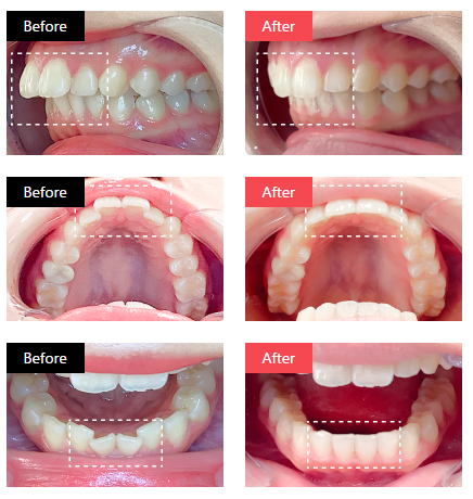 Oh my teethの症例