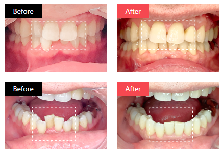 Oh my teethの症例