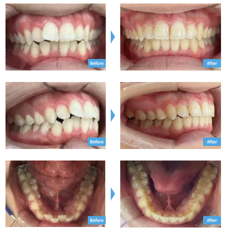 スマイルモアの良い口コミから悪い評判まで徹底紹介!後悔しないために知っておきたいことまとめ! 7 スマイルモアの症例