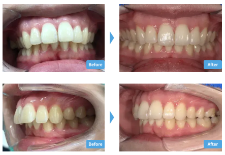 スマイルモアの良い口コミから悪い評判まで徹底紹介!後悔しないために知っておきたいことまとめ! 8 スマイルモアの症例
