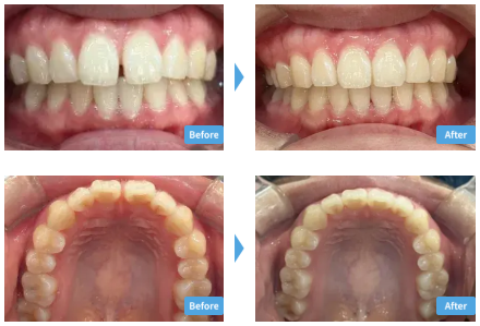 スマイルモアの良い口コミから悪い評判まで徹底紹介!後悔しないために知っておきたいことまとめ! 9 スマイルモアの症例