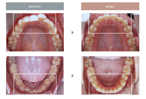 エミニナル矯正の症例