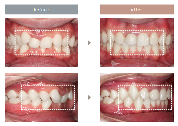 エミニナル矯正の症例