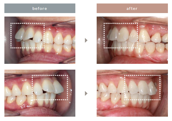 エミニナル矯正の症例