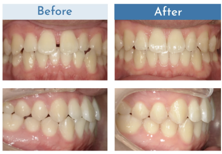 DDデンタルクリニックのインビザライン矯正の口コミ・評判はどう?実際に利用した患者さんからの声をご紹介! 6 DDデンタルクリニックのインビザライン矯正の症例
