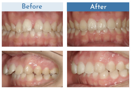 DDデンタルクリニックのインビザライン矯正の口コミ・評判はどう?実際に利用した患者さんからの声をご紹介! 7 DDデンタルクリニックのインビザライン矯正の症例