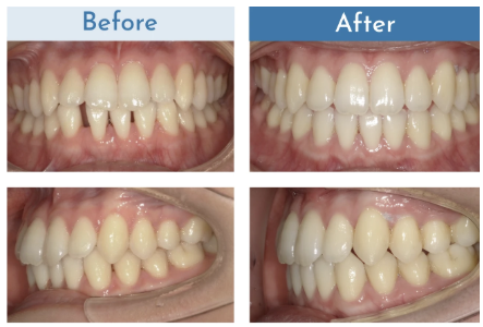 DDデンタルクリニックのインビザライン矯正の口コミ・評判はどう?実際に利用した患者さんからの声をご紹介! 8 DDデンタルクリニックのインビザライン矯正の症例